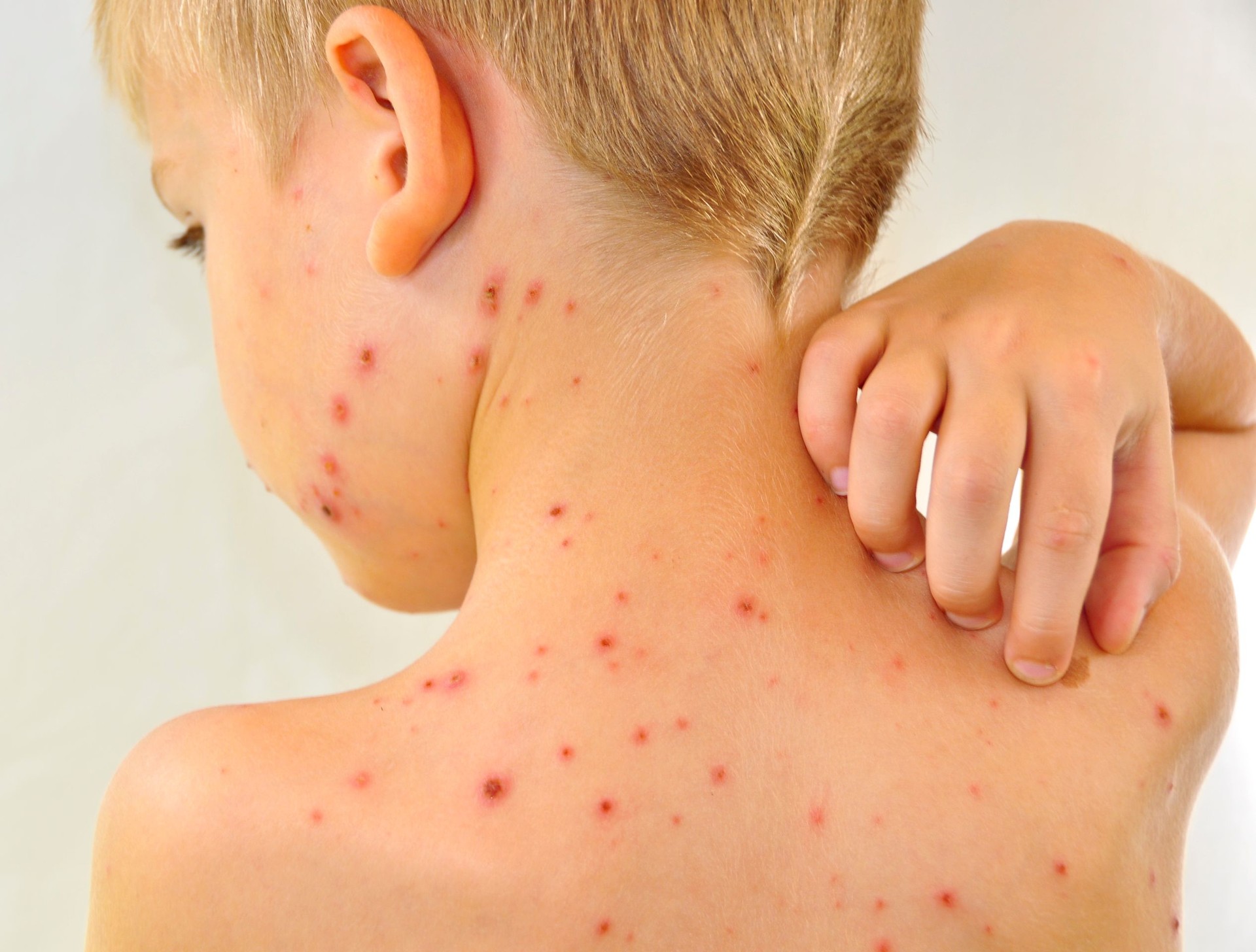 Little boy scratching me his chickenpox