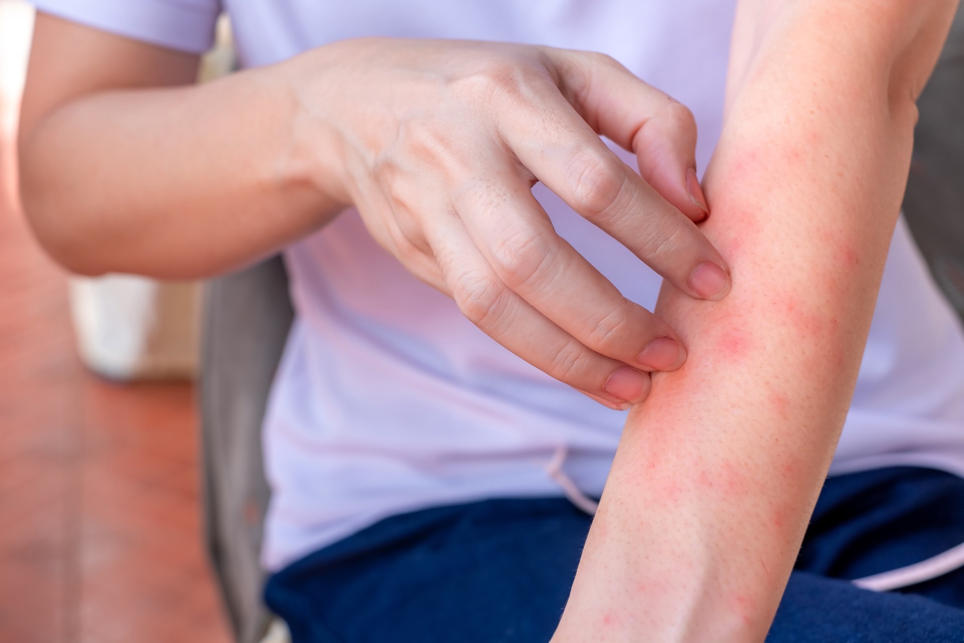 Close up of woman arm scratch the itch by hand at home, itching due to rash, fungus, allergy, dermatological disease, dry skin. Healthcare and medical concept.