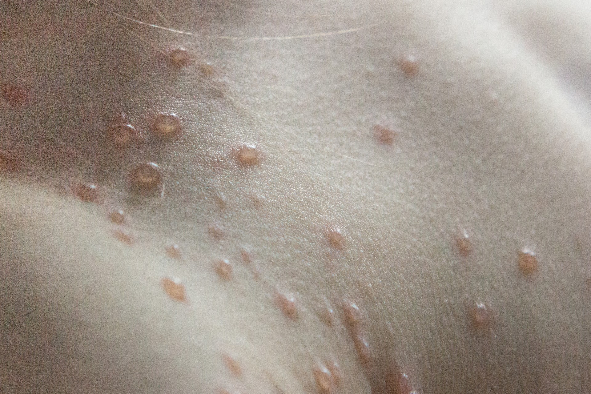 Chickenpox vesicle blisters on a child's shoulder and chest